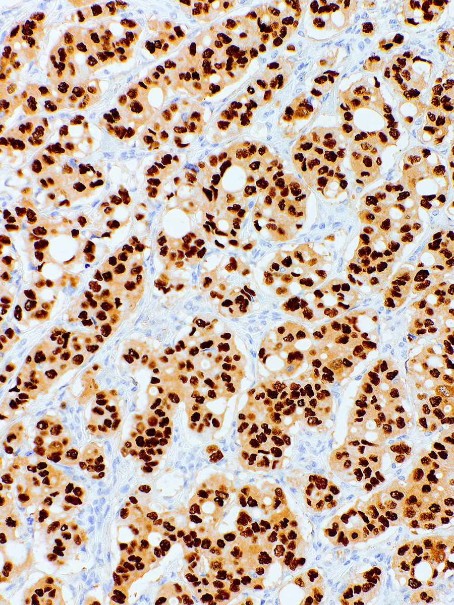 Progesterone Receptor Mouse Monoclonal Antibody(ARM898)