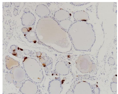Procalcitonin Rabbit Monoclonal Antibody(ARB533)