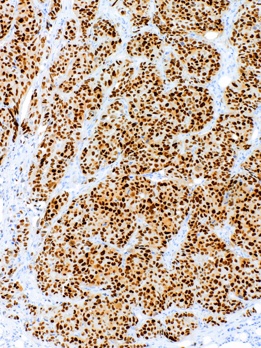 Estrogen Receptor Rabbit Monoclonal Antibody(ARM883)
