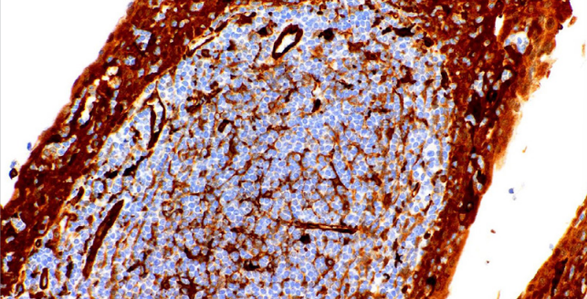 Fascin Mouse Monoclonal Antibody(ARM990)